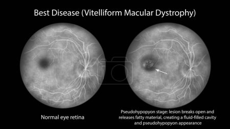 Foto de La mejor enfermedad, una ilustración que muestra retina ocular normal y la mejor distrofia macular vitelliforme, etapa Pseudohypopyon con capas de lipofuscin en angiografía fluorescein - Imagen libre de derechos