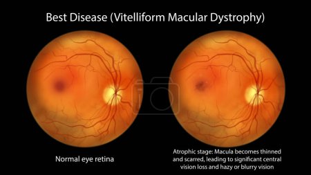 Photo for Best disease, an illustration showing normal eye retina and Best vitelliform macular dystrophy in atrophic stage with retinal atrophy and scar formation, ophthalmoscope view - Royalty Free Image