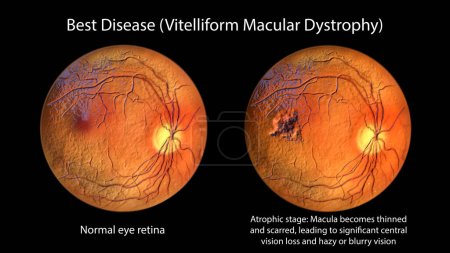 Photo for Best disease, 3D illustration showing normal eye retina and Best vitelliform macular dystrophy in atrophic stage with retinal atrophy and scar formation, ophthalmoscope view - Royalty Free Image