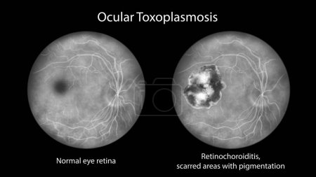 Photo for Retinal scar in toxoplasmosis, a disease caused by the single-celled protozoan Toxoplasma gondii, and the same healthy eye retina for comparison, fluorescein angiography, scientific illustration - Royalty Free Image