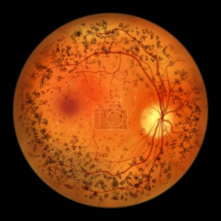 Photo for Autosomal dominant vitreoretinochoroidopathy, a rare genetic disorder that affects the retina, vitreous, and choroid, an illustration showing circular band of hyperpigmentation in the retina - Royalty Free Image