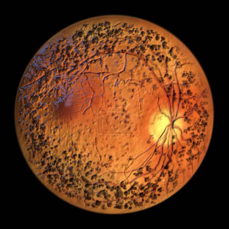 Photo for Autosomal dominant vitreoretinochoroidopathy, a rare genetic disorder that affects the retina, vitreous, and choroid, 3D illustration showing circular band of hyperpigmentation in the retina - Royalty Free Image