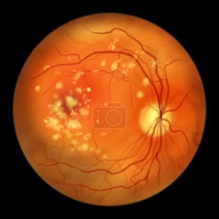 Bestrofinopatía autosómica recesiva, vista oftalmoscópica, ilustración científica que muestra acumulación de depósitos de lipofuscina alrededor y más allá de la mácula que conduce a daño progresivo a la retina