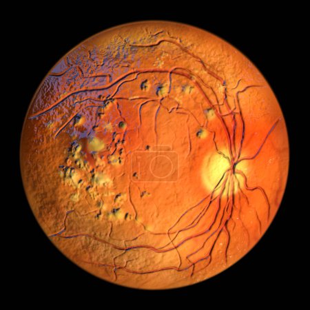 Photo for Autosomal recessive bestrophinopathy, ophthalmoscope view, 3D illustration showing accumulation of lipofuscin deposits around and beyond the macula leading to progressive damage to the retina - Royalty Free Image