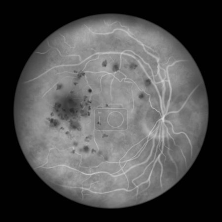 Téléchargez les photos : Bestrophinopathie autosomique récessive, illustration scientifique montrant l'accumulation de dépôts de lipofuscine autour et au-delà de la macula conduisant à des lésions rétiniennes progressives, angiographie fluorescéine - en image libre de droit
