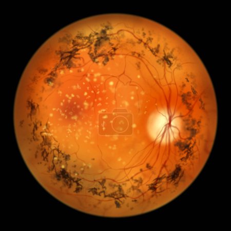 Foto de Retinitis pigmentosa, una enfermedad genética ocular. Una ilustración muestra depósitos de pigmento en la retina, vasos sanguíneos atenuados, espículas óseas pigmentarias y aspecto ceroso del disco óptico - Imagen libre de derechos