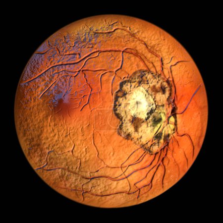 Foto de Cicatriz retiniana en toxoplasmosis, una enfermedad causada por el protozoo unicelular Toxoplasma gondii, vista oftalmoscopio, ilustración 3D - Imagen libre de derechos