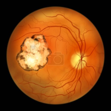 Retinal scar in toxoplasmosis, a disease caused by the single-celled protozoan Toxoplasma gondii, ophthalmoscope view, scientific illustration