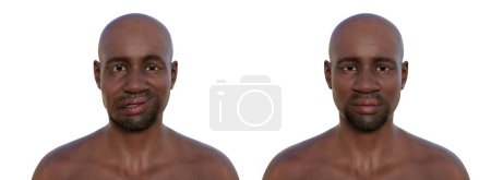 Gesichtslähmung bei einem Afrikaner und demselben gesunden Mann, fotorealistische 3D-Illustration, die die Asymmetrie und Hängung der Gesichtsmuskeln auf einer Seite des Gesichts hervorhebt