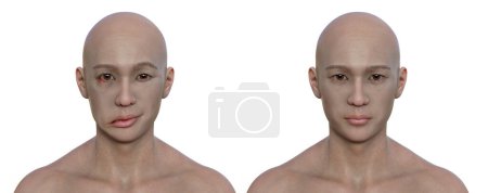 Téléchargez les photos : La paralysie faciale chez un homme et le même homme en bonne santé, illustration 3D photoréaliste soulignant l'asymétrie et l'affaissement des muscles faciaux d'un côté du visage - en image libre de droit