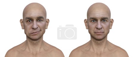 Facial palsy in a man and the same healthy man, photorealistic 3D illustration highlighting the asymmetry and drooping of the facial muscles on one side of the face
