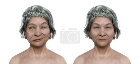 Téléchargez les photos : La paralysie faciale chez une femme et la même personne en bonne santé, illustration 3D photoréaliste soulignant l'asymétrie et l'affaissement des muscles faciaux d'un côté du visage - en image libre de droit