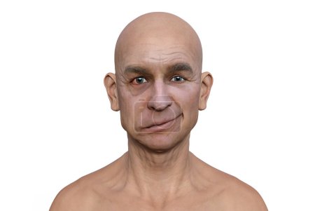 Téléchargez les photos : La paralysie faciale chez un homme, illustration 3D photoréaliste mettant en évidence l'asymétrie et le fléchissement des muscles faciaux d'un côté du visage - en image libre de droit