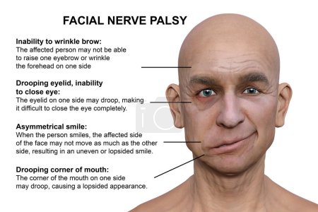 Gesichtslähmung bei einem Mann, fotorealistische 3D-Illustration, die die Asymmetrie und Hängung der Gesichtsmuskeln auf einer Seite des Gesichts hervorhebt