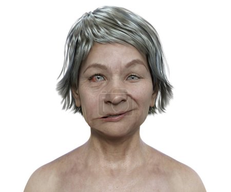 Téléchargez les photos : La paralysie faciale chez une femme, illustration 3D photoréaliste soulignant l'asymétrie et le affaissement des muscles faciaux d'un côté du visage - en image libre de droit