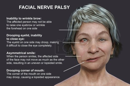 Téléchargez les photos : La paralysie faciale chez une femme, illustration 3D photoréaliste soulignant l'asymétrie et le affaissement des muscles faciaux d'un côté du visage - en image libre de droit