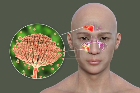 Foto de Aspergillus fungi como causa de sinusitis. Ilustración 3D que muestra inflamación de los senos maxilares en un hombre y vista de cerca del hongo Aspergillus. rinosinusitis fúngica. Complicación de Covid-19 - Imagen libre de derechos