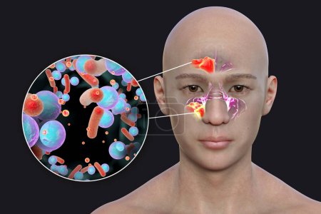 Photo for Sinusitis, inflammation of paranasal cavities. 3D illustration showing purulent inflammation of frontal and maxillary sinuses in a man and close-up view of bacteria that cause sinusitis - Royalty Free Image
