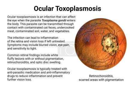 Téléchargez les photos : Toxoplasmose oculaire, une maladie causée par le protozoaire unicellulaire Toxoplasma gondii. Illustration 3D scientifique montrant une cicatrice rétinienne - en image libre de droit