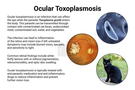 Téléchargez les photos : Toxoplasmose oculaire, une maladie causée par le protozoaire unicellulaire Toxoplasma gondii. Illustration 3D scientifique montrant une cicatrice rétinienne - en image libre de droit