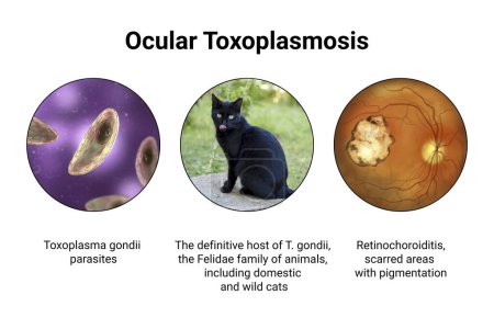 Photo for Ocular toxoplasmosis, a disease caused by the single-celled protozoan Toxoplasma gondii. Scientific 3D illustration showing retinal scar - Royalty Free Image