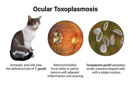 Photo for Ocular toxoplasmosis, a disease caused by the single-celled protozoan Toxoplasma gondii. Scientific 3D illustration showing retinal scar - Royalty Free Image