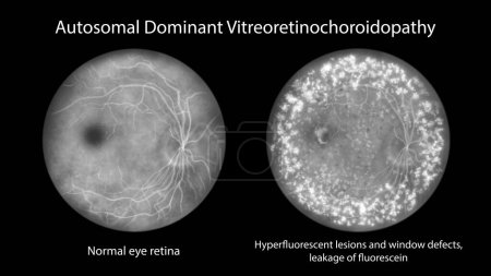 Photo for Autosomal dominant vitreoretinochoroidopathy, an illustration showing normal eye retina and retina with hyperfluorescent lesions, windows defects, and leakage of lipofuscin on fluorescein angiogram - Royalty Free Image