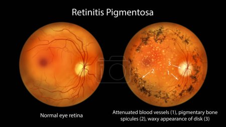 Téléchargez les photos : Retinitis pigmentosa, une maladie génétique des yeux. Une illustration montre une rétine oculaire normale et des vaisseaux sanguins atténués, des spicules osseuses pigmentaires et l'aspect cireux du disque optique dans la rétine affectée. - en image libre de droit
