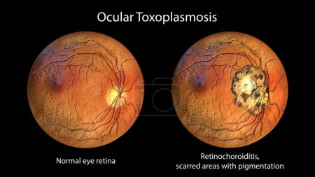 Foto de Cicatriz retiniana en toxoplasmosis, una enfermedad causada por el protozoario unicelular Toxoplasma gondii, y la misma retina ocular sana para comparación, vista oftalmoscopio, ilustración 3D - Imagen libre de derechos