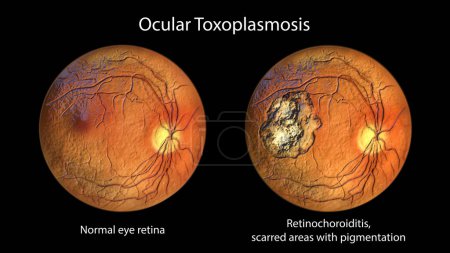 Photo for Retinal scar in toxoplasmosis, a disease caused by the single-celled protozoan Toxoplasma gondii, and the same healthy eye retina for comparison, ophthalmoscope view, 3D illustration - Royalty Free Image