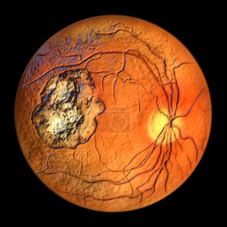 Téléchargez les photos : Cicatrice rétinienne dans la toxoplasmose, une maladie causée par le protozoaire unicellulaire Toxoplasma gondii, vue ophtalmoscopique, illustration 3D - en image libre de droit