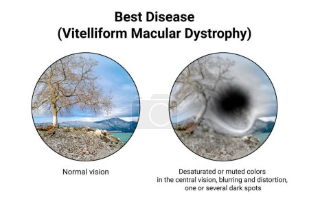 Photo for The difference between the vision of a normal eye and an eye affected by Best disease, illustration showing desatured colors in the central vision, blurring, distortion, black spot - Royalty Free Image