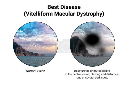 Photo for The difference between the vision of a normal eye and an eye affected by Best disease, illustration showing desatured colors in the central vision, blurring, distortion, black spot - Royalty Free Image