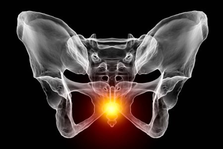 Una ilustración médica en 3D que resalta el hueso del coxis marcado en rojo, que representa el dolor del coxis que puede ocurrir debido a una lesión, parto o estar sentado prolongado. Vista frontal