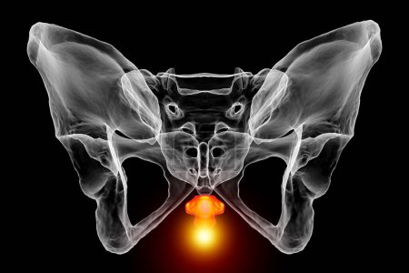 Foto de Una ilustración médica en 3D que resalta el hueso del coxis marcado en rojo, que representa el dolor del coxis que puede ocurrir debido a una lesión, parto o estar sentado prolongado. Vista frontal - Imagen libre de derechos