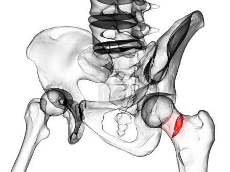 Téléchargez les photos : Fracture du cou du fémur, un type commun de fracture de la hanche qui survient généralement chez les personnes âgées et qui peut entraîner des problèmes de mobilité et d'autres complications, isolé sur fond blanc, illustration 3D - en image libre de droit