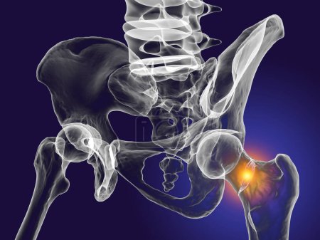 Fractura del cuello del fémur, un tipo común de fractura de cadera que ocurre típicamente en adultos mayores y puede conducir a problemas de movilidad y otras complicaciones, aislado sobre fondo blanco, ilustración 3D