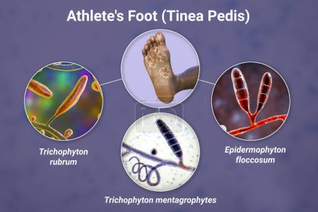 Foto de El pie de una persona de piel oscura con micosis, y vista de cerca de los hongos Epidermophyton floccosum, Trichophyton mentagrophytes y T. rubrum que causan pie de atleta, ilustración 3D - Imagen libre de derechos