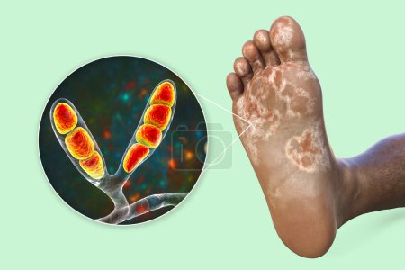 Téléchargez les photos : Le pied d'une personne à la peau foncée avec mycose, et vue rapprochée des champignons Epidermophyton floccosum qui causent le pied d'athlète, illustration 3D - en image libre de droit