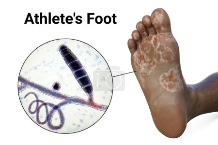 Téléchargez les photos : Le pied d'une personne à la peau foncée avec mycose, et vue rapprochée des champignons Trichophyton mentagrophytes qui causent le pied d'athlète, illustration 3D - en image libre de droit