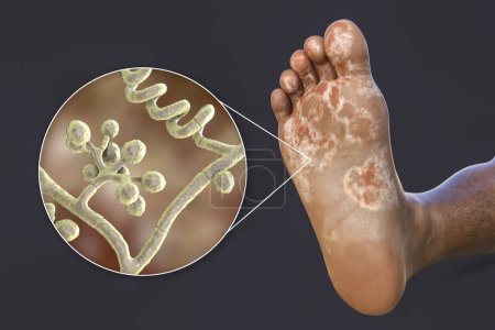 Photo for The foot of a dark-skinned person with mycosis, and close-up view of fungi Trichophyton mentagrophytes that cause Athlete's foot, 3D illustration - Royalty Free Image