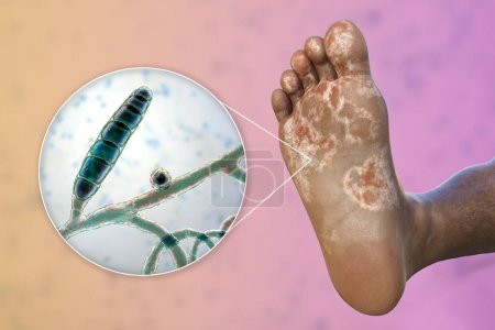 Photo for The foot of a dark-skinned person with mycosis, and close-up view of fungi Trichophyton mentagrophytes that cause Athlete's foot, 3D illustration - Royalty Free Image