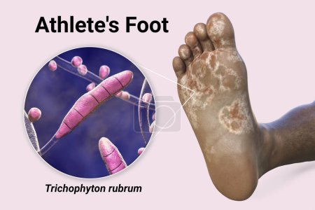 Photo for The foot of a dark-skinned person with mycosis, and close-up view of fungi Trichophyton rubrum that cause Athlete's foot, 3D illustration - Royalty Free Image