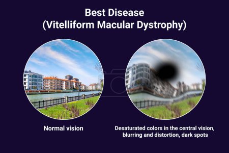 The difference between the vision of a normal eye and an eye affected by Best disease, illustration showing desatured colors in the central vision, blurring, distortion, black spot