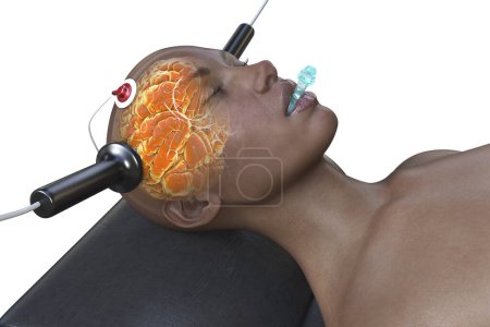 Photo for Electroconvulsive therapy, ECT, a treatment used for severe mental illnesses involving the use of electrical currents to stimulate the brain, 3D illustration - Royalty Free Image