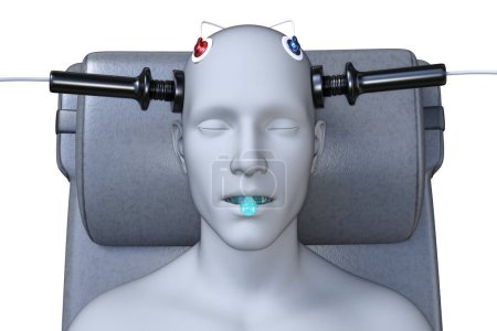 Elektrokrampftherapie, EKT, eine Behandlung bei schweren psychischen Erkrankungen, bei der elektrische Ströme eingesetzt werden, um das Gehirn zu stimulieren, 3D-Illustration