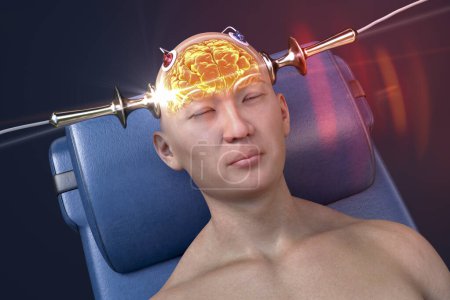 Téléchargez les photos : Thérapie électroconvulsive, ECT, un traitement utilisé pour les maladies mentales graves impliquant l'utilisation de courants électriques pour stimuler le cerveau, illustration 3D - en image libre de droit