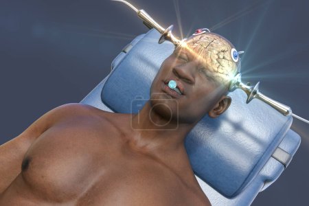 Photo for Electroconvulsive therapy, ECT, a treatment used for severe mental illnesses involving the use of electrical currents to stimulate the brain, 3D illustration - Royalty Free Image
