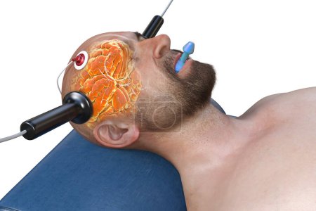 Elektrokrampftherapie, EKT, eine Behandlung bei schweren psychischen Erkrankungen, bei der elektrische Ströme eingesetzt werden, um das Gehirn zu stimulieren, 3D-Illustration