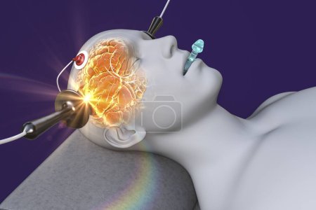 Foto de Terapia electroconvulsiva, ECT, un tratamiento utilizado para enfermedades mentales graves que implican el uso de corrientes eléctricas para estimular el cerebro, ilustración 3D - Imagen libre de derechos